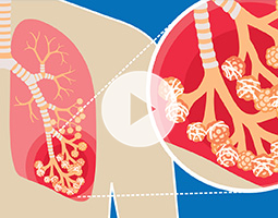How ILD Affects the Lungs illustration.