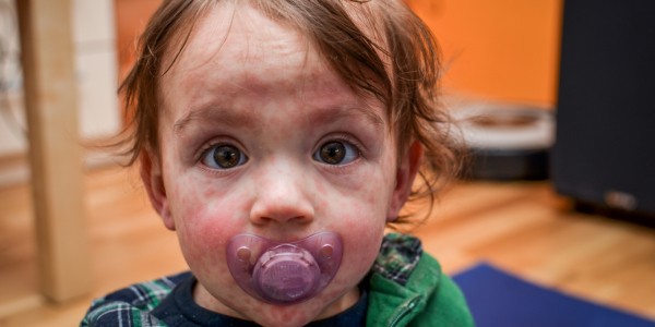 Young child with measles