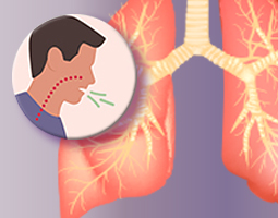 Bronchiectasis illustration